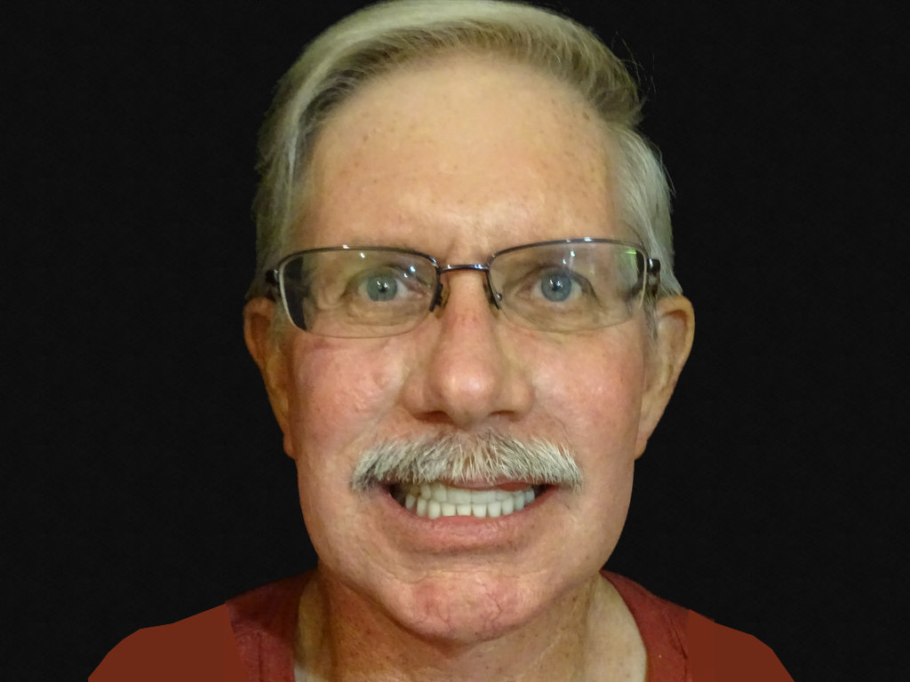 https://www.dentalimplantscr.com/wp-content/uploads/2016/11/Terry-nivens-after-dental-implants.jpg