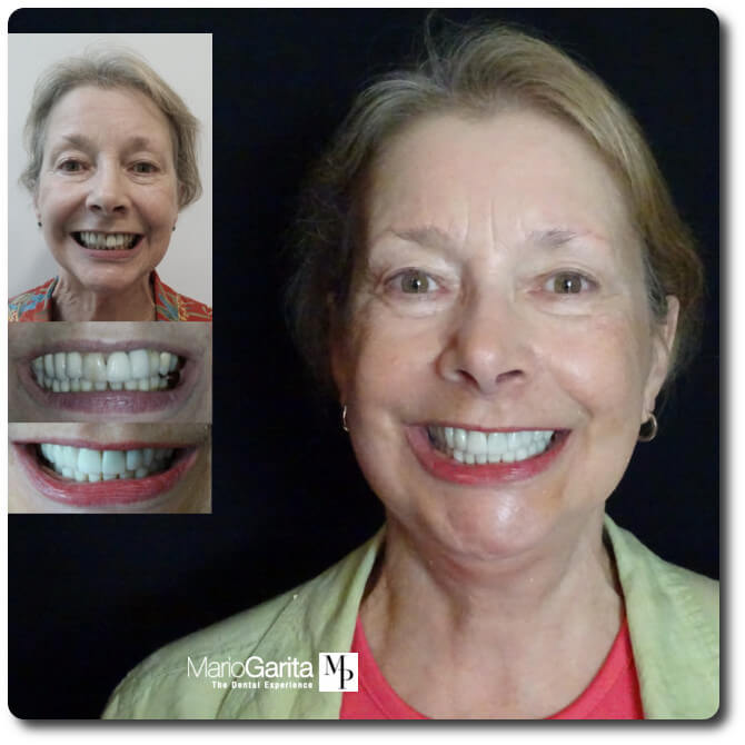 https://www.dentalimplantscr.com/wp-content/uploads/2017/02/Doris-Iaroli-before-and-after.jpg