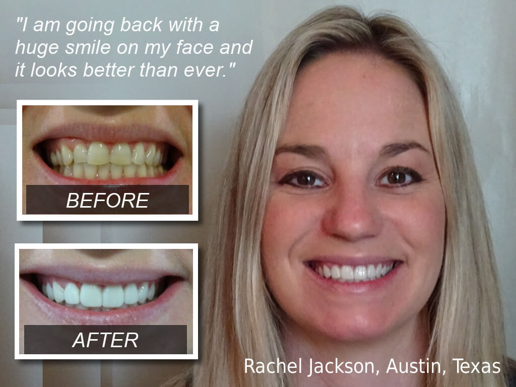 https://www.dentalimplantscr.com/wp-content/uploads/2020/01/Rachel-Jackson.jpg