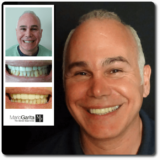 https://www.dentalimplantscr.com/wp-content/uploads/2024/04/02-Kevin-Sorce-veneers-160x160.png